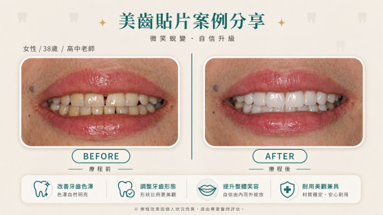 改善牙齒泛黃，找回自然明亮笑容