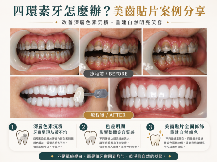 四環素染色（重度色素型）
