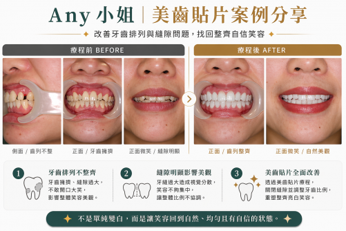 美齒貼片全面調整，重建自然笑容